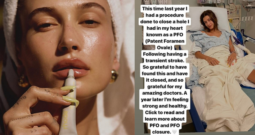 Justin Bieber’s wife says it has been one year since her surgery to close up a hole in her heart following a stroke as she adds she is feeling ‘healthy’